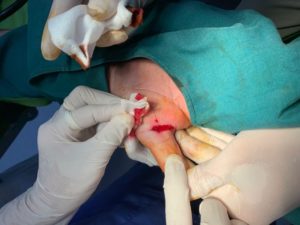BS. Thanh Phy và cộng sự Mổ viêm gân gấp ngón